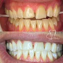 Shine Laser Teeth Whitening Spa