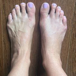 Left foot untreated. Rught foot treated.