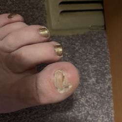 This is my toe after visiting this establishment.  I am going to a podiatrist tomorrow.