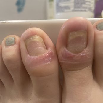 Nailed It Spa - After four consecutive rounds of antibiotics, before the nails were removed. 8/26/2022 - Nail Salons Near Me - Fresno, California Nailed It Spa - After four consecutive rounds of antibiotics, before the nails were removed. 8/26/2022 - Nail Salons Near Me - Fresno, California