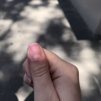 Dashing Diva Salon - Stained nails from incorrect gel manicure. - Day Spas Near Me - Brooklyn, New York Dashing Diva Salon - Stained nails from incorrect gel manicure. - Day Spas Near Me - Brooklyn, New York