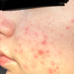 Clear Complexions - This was my skin when I first came in.