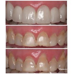 Gingival graft & Veneers