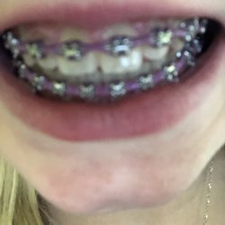Rothenberg Orthodontics - Front braces