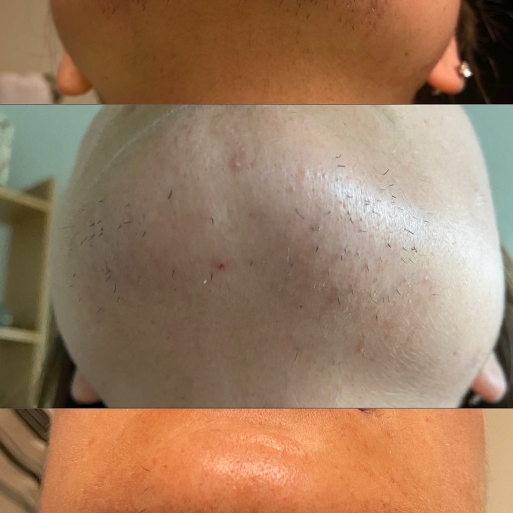 Bare Electrolysis - Hair Removal Near Me - San Diego, California