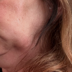 Jeffrey C Sklarin, DDS - Infection on the nerve from Dr. Sklarin