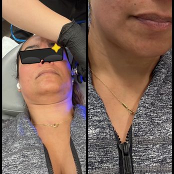 OVME - Process and after flow of a hydrofacial. Ask for Tina - Medical Spas Near Me - Fairfax, Virginia