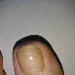 paris nail salon - Sliced Toe nail = A lot of pain for months.