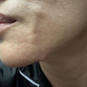 Diamond Med Spa - this is after a month and a return visit where she did nothing to alleviate the protrusion and said it would naturally disolve. - Medical Spas Near Me - Miami Beach, Florida Diamond Med Spa - this is after a month and a return visit where she did nothing to alleviate the protrusion and said it would naturally disolve. - Medical Spas Near Me - Miami Beach, Florida