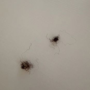 Balm & Bubble: medspa + wellness - 2 balled up strands of hair from two separate braids along my hairline - Skin Care Near Me - Austin, Texas Balm & Bubble: medspa + wellness - 2 balled up strands of hair from two separate braids along my hairline - Skin Care Near Me - Austin, Texas