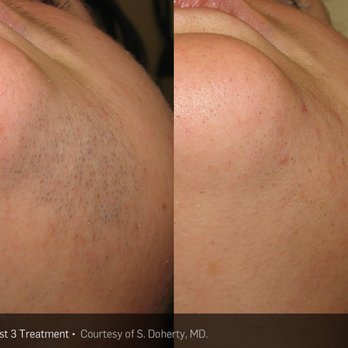 Iris Beauty Solution - Laser Hair Removal Near Me - Vancouver, British Columbia