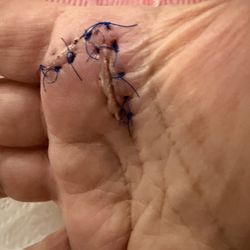 Ohio State's Eye and Ear Institute - A picture of my sugery