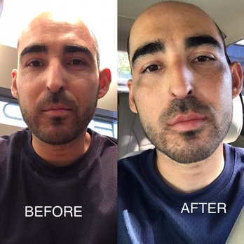 Rosenberg Plastic Surgery - Juvederm Ultra XC  (about 1/2 syringe on upper lip only) - Cosmetic Surgeons Near Me - Beverly Hills, California