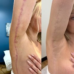 Halo Skin And Scar - Amazing transformation in this Brachial Scar camouflage by artist, Jazzie Craig. All rights reserved.