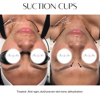 The Beauty Cosmo - Glowing Dermaplane facial + suction cup add on treatment - Waxing Near Me - Hayward, California The Beauty Cosmo - Glowing Dermaplane facial + suction cup add on treatment - Waxing Near Me - Hayward, California