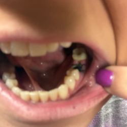 Maria Concepcion, DMD - Advanced Endodontics - Lost tooth