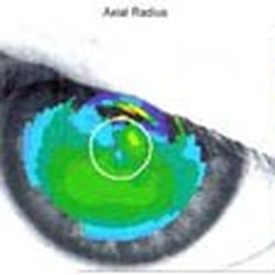Robinson & Parker - Corneal Topography