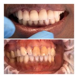 Crystal Bright Smile - When Bonding Fails, All Ceramic Zirconia Crowns never fails.
