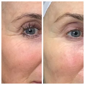 Livio Med Spa - After 2 microneedling treatments, nothing else! - Skin Care Near Me - Cincinnati, Ohio Livio Med Spa - After 2 microneedling treatments, nothing else! - Skin Care Near Me - Cincinnati, Ohio