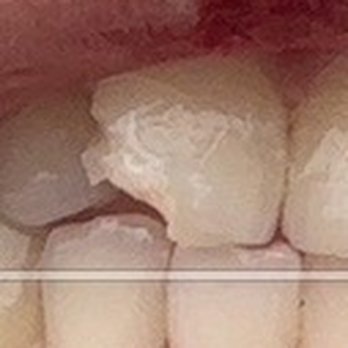 Arlington Advanced Dental Care - Broke the incisor - General Dentistry Near Me - Arlington, Virginia Arlington Advanced Dental Care - Broke the incisor - General Dentistry Near Me - Arlington, Virginia