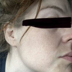 Maffi Plastic Surgery - Face results from BBL