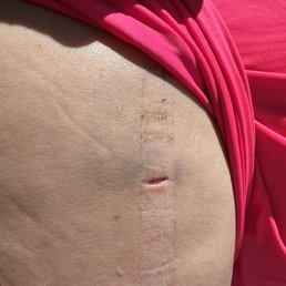Incision that did not heal properly, I contacted the doctor for help and he did not reply to my email.