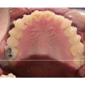 Markham Orthodontics - 2023 April (ending treatment in September) - Orthodontists Near Me - Sacramento, California