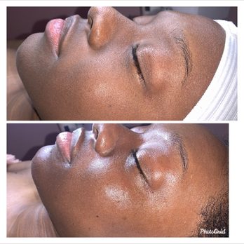 Beyouskinn - Before and after facial treatment - Skin Care Near Me - Tampa, Florida Beyouskinn - Before and after facial treatment - Skin Care Near Me - Tampa, Florida
