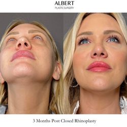 Mark G Albert, MD - Closed (Scarless) Rhinoplasty