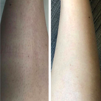 Chateau Gena - Laser hair removal after 7 sessions - Hair Salons Near Me - Skokie, Illinois