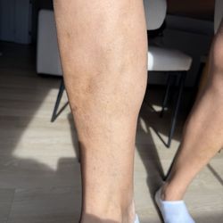 Vein Specialty Medical Clinic - Front of the shin, post surgery, no more bulging veins