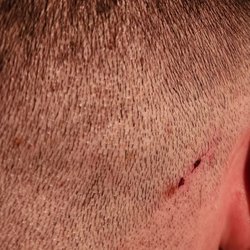 H and L barber shop - Cut on back of head