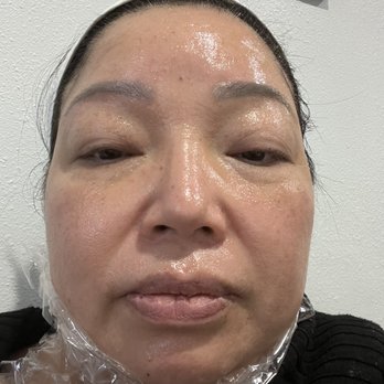 Lumex Beauty - Before treatment - Medical Spas Near Me - Garden Grove, California Lumex Beauty - Before treatment - Medical Spas Near Me - Garden Grove, California