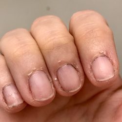 Signature Nails Spa - What happens to me when cuticles are yanked when cut. Pls don't do this to others. *disregard the blk polish, that's the work of my 11yr old