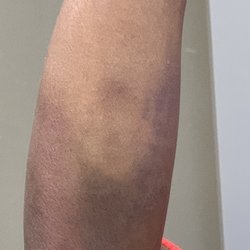 Dugas Jeffrey, MD - Arm after Dr. Jeff Dugas drew blood himself.