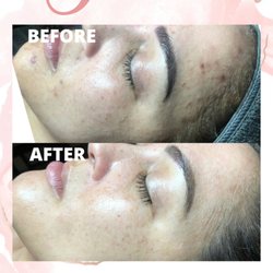 Alexis Nicolette Skin Boutique - Microneedling & Facial