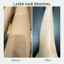 IAM Radiance - Laser Hair Removal Before and After