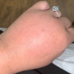 East Georgia Regional Medical Center - Allergic reaction.