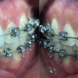 Acecare Dental & Orthodontics - Teeth whitening