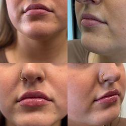 Glowing Complexions - Before and after half syringe of filler in the lips