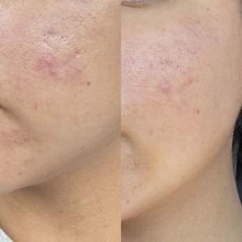 Skin BY V - This was a week after the first time I saw her and my skin was already showing improvement! - Skin Care Near Me Skin BY V - This was a week after the first time I saw her and my skin was already showing improvement! - Skin Care Near Me