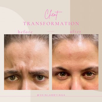 Skin Lab by Inga RN - My lovely clients Botox results. - Medical Spas Near Me - Johns Creek, Georgia Skin Lab by Inga RN - My lovely clients Botox results. - Medical Spas Near Me - Johns Creek, Georgia