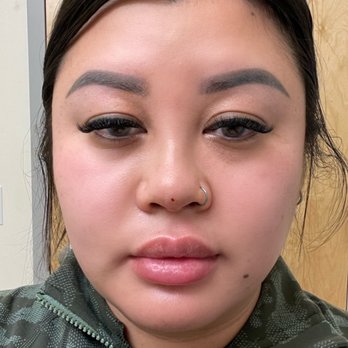 Btoxbar - Results right after the thread lift - Medical Spas Near Me - Los Gatos, California