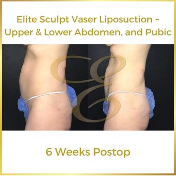 Elite MD - Before and after vaser lipo and J-plasma of abdomen, 6 weeks after surgery. - Cosmetic Surgeons Near Me - Danville, California