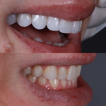 Joseph Goodman, DDS, DMD - No prep veneers and bite corrections from TMJ pain
No shot
No drilling
No pain
Patient flew in from Michigan
Shade 1m1 - General Dentistry Near Me - Beverly Hills, California Joseph Goodman, DDS, DMD - No prep veneers and bite corrections from TMJ pain
No shot
No drilling
No pain
Patient flew in from Michigan
Shade 1m1 - General Dentistry Near Me - Beverly Hills, California
