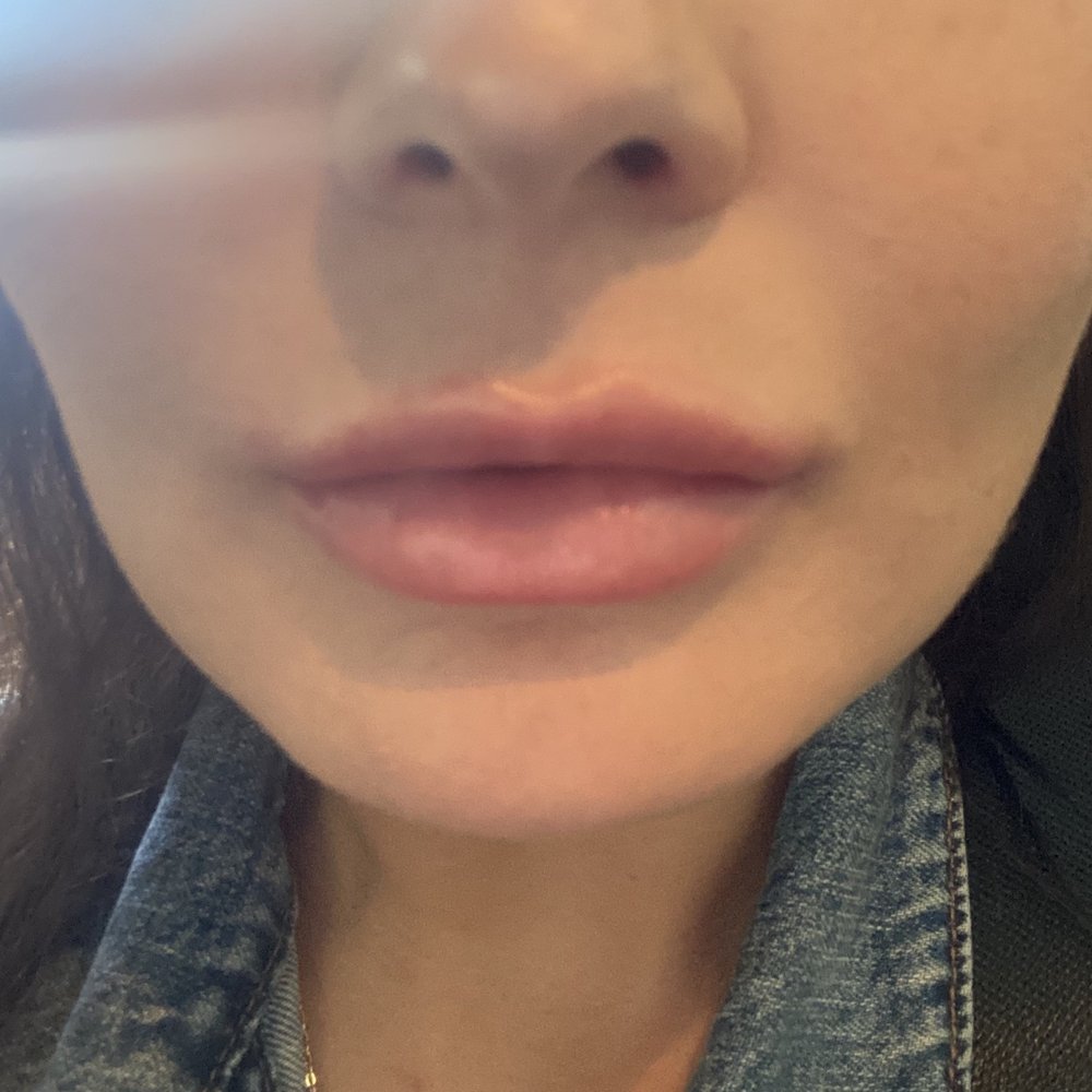 Barrett Plastic Surgery - Lip filler - Cosmetic Surgeons Near Me - Beverly Hills, California Barrett Plastic Surgery - Lip filler - Cosmetic Surgeons Near Me - Beverly Hills, California
