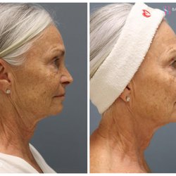Baby Smooth Aesthetics - Say hello to the latest and greatest in skin rejuvenation
Introducing Pixel 8-RF.