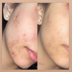 Microchanneling is the new microneedling, let's get you healthy skin!