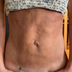 Constantino Mendieta, MD FACS - 4 Beauty - Result after 6 months