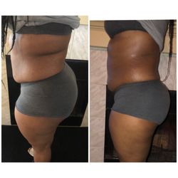Houston’s Hollywood Body Spa - Before and after Ultrasonic Cavitation